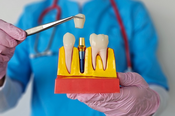 Bone And Gum Grafting Before Dental Implant Placement